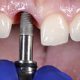 Implantes dentales Mérida