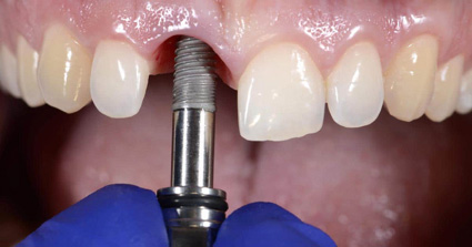 Implantes dentales Mérida